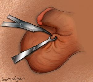 No-scalpel vasectomy technique