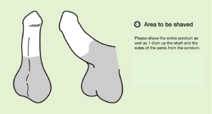 Diagram showing the area of the genitals where hair needs to be removed prior to a vasectomy